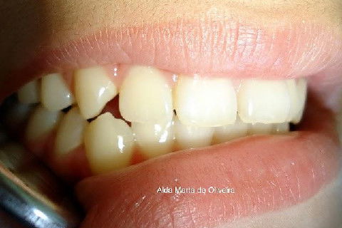 Pericementite Traumática Elemento 13