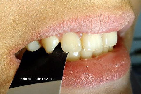 Pericementite Traumática Elemento 13