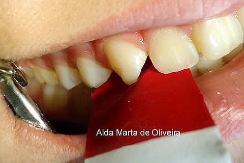 Pericementite Traumática Elemento 13