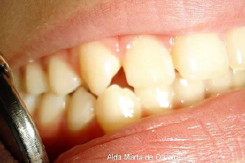 Pericementite Traumática Elemento 13