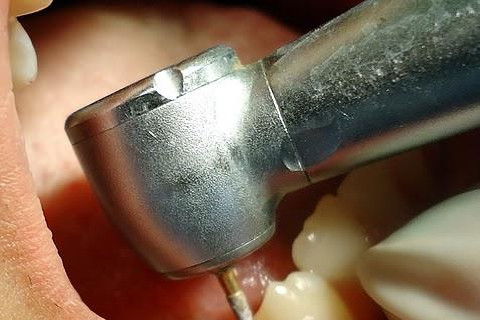 Pericementite Traumática Elemento 13