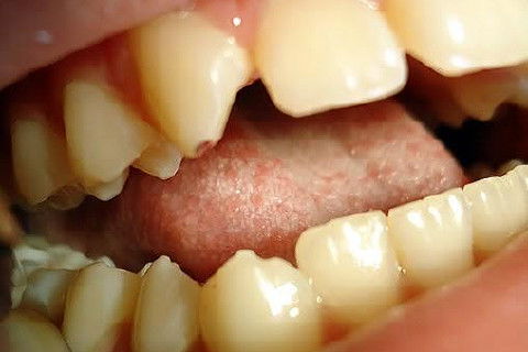 Pericementite Traumática Elemento 13