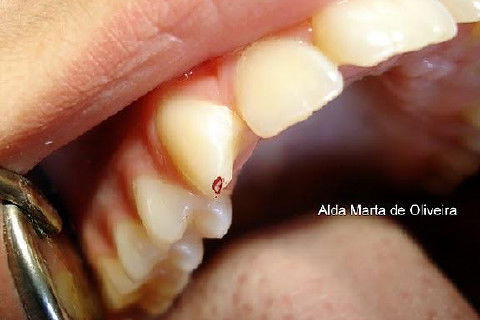 Pericementite Traumática Elemento 13