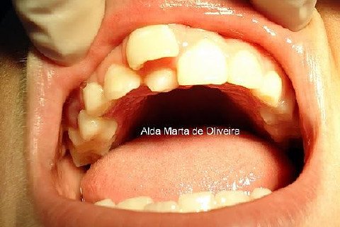 Hiperdontia: Supranumerário na Região Palatina do Dente 11