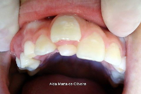 Hiperdontia: Supranumerário na Região Palatina do Dente 11