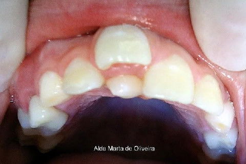 Hiperdontia: Supranumerário na Região Palatina do Dente 11