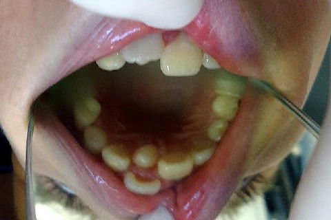 Hiperdontia: Supranumerário na Região Palatina do Dente 11