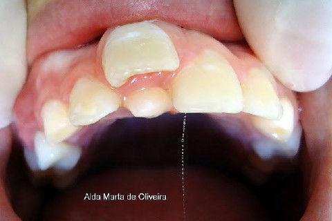 Hiperdontia: Supranumerário na Região Palatina do Dente 11