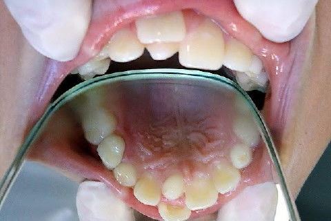 Hiperdontia: Supranumerário na Região Palatina do Dente 11