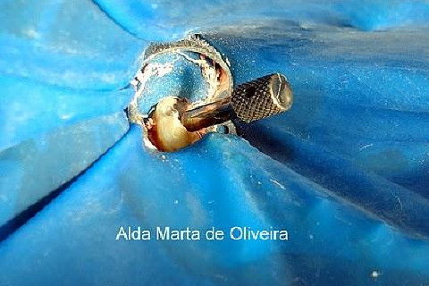 Pino Rosqueável e Núcleo de Preenchimento com Resina Dente 47