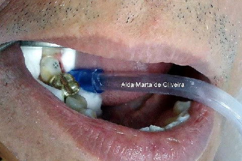 Pino Rosqueável e Núcleo de Preenchimento com Resina Dente 47