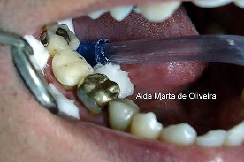 Pino Rosqueável e Núcleo de Preenchimento com Resina Dente 47