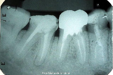 Pino Rosqueável e Núcleo de Preenchimento com Resina Dente 47