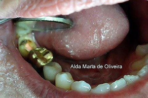 Pino Rosqueável e Núcleo de Preenchimento com Resina Dente 47