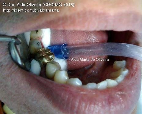 Pino Rosqueável e Núcleo de Preenchimento com Resina Dente 47