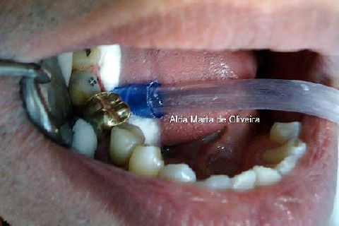 Pino Rosqueável e Núcleo de Preenchimento com Resina Dente 47