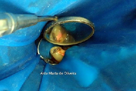 Pino Rosqueável e Núcleo de Preenchimento com Resina Dente 47