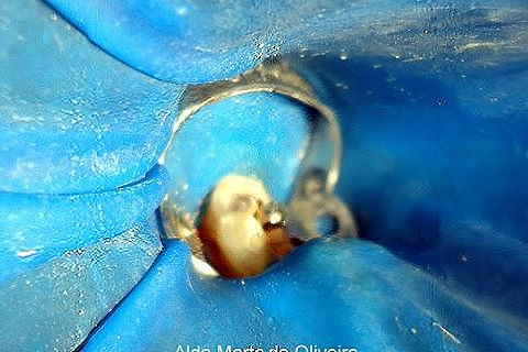 Pino Rosqueável e Núcleo de Preenchimento com Resina Dente 47