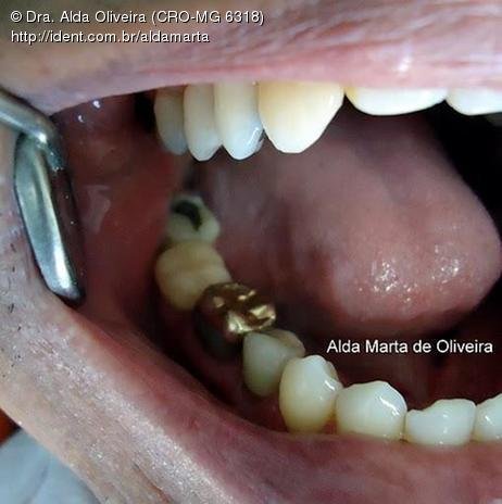 Pino Rosqueável e Núcleo de Preenchimento com Resina Dente 47