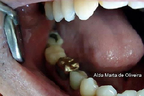 Pino Rosqueável e Núcleo de Preenchimento com Resina Dente 47