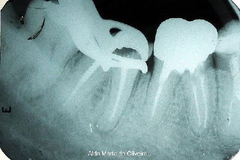 Pino Rosqueável e Núcleo de Preenchimento com Resina Dente 47