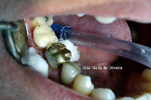 Pino Rosqueável e Núcleo de Preenchimento com Resina Dente 47