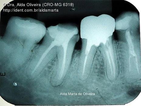 Pino Rosqueável e Núcleo de Preenchimento com Resina Dente 47