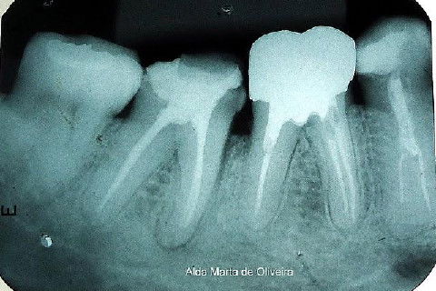 Pino Rosqueável e Núcleo de Preenchimento com Resina Dente 47