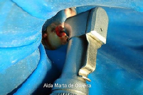 Pino Rosqueável e Núcleo de Preenchimento com Resina Dente 47