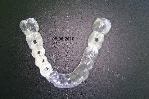 Reabilitação Oral - 10 Implantes Maxila e Mandíbula - Parte I - Planejamento