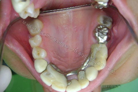 Reabilitação Oral - 10 Implantes Maxila e Mandíbula - Parte I - Planejamento