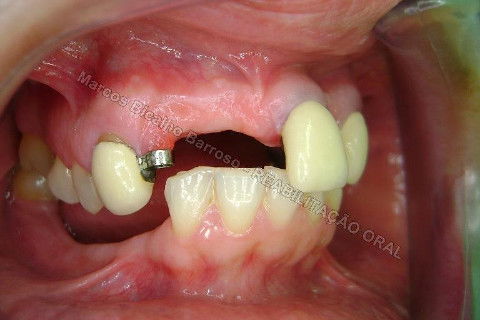 Reabilitação Oral - 10 Implantes Maxila e Mandíbula - Parte I - Planejamento