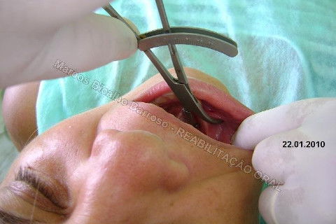Reabilitação Oral - 10 Implantes Maxila e Mandíbula - Parte I - Planejamento
