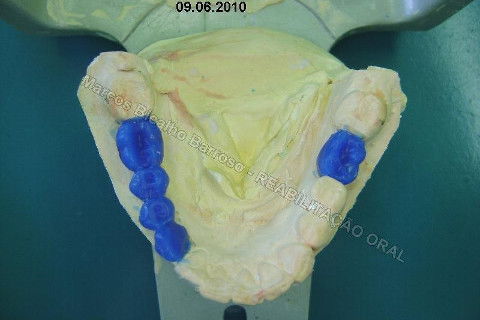 Reabilitação Oral - 10 Implantes Maxila e Mandíbula - Parte I - Planejamento