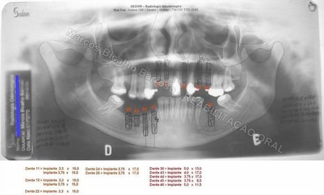 Reabilitação Oral - 10 Implantes Maxila e Mandíbula - Parte I - Planejamento