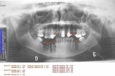 Reabilitação Oral - 10 Implantes Maxila e Mandíbula - Parte I - Planejamento
