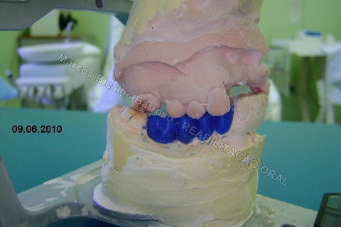 Reabilitação Oral - 10 Implantes Maxila e Mandíbula - Parte I - Planejamento