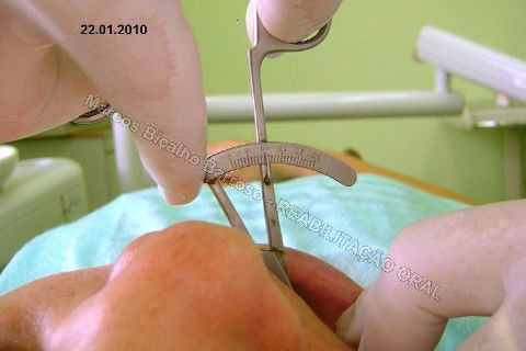 Reabilitação Oral - 10 Implantes Maxila e Mandíbula - Parte I - Planejamento