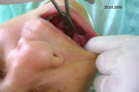 Reabilitação Oral - 10 Implantes Maxila e Mandíbula - Parte I - Planejamento