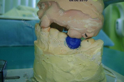 Reabilitação Oral - 10 Implantes Maxila e Mandíbula - Parte I - Planejamento