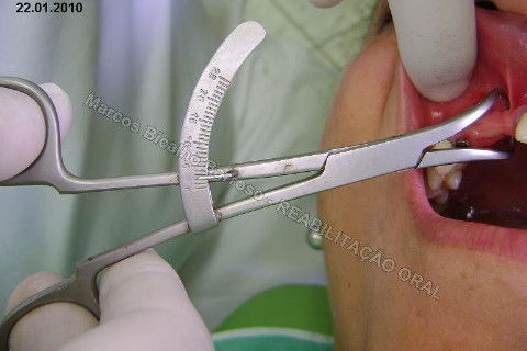 Reabilitação Oral - 10 Implantes Maxila e Mandíbula - Parte I - Planejamento