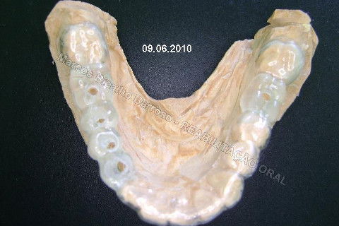 Reabilitação Oral - 10 Implantes Maxila e Mandíbula - Parte I - Planejamento