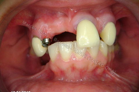 Reabilitação Oral - 10 Implantes Maxila e Mandíbula - Parte I - Planejamento