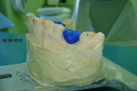 Reabilitação Oral - 10 Implantes Maxila e Mandíbula - Parte I - Planejamento