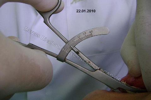 Reabilitação Oral - 10 Implantes Maxila e Mandíbula - Parte I - Planejamento