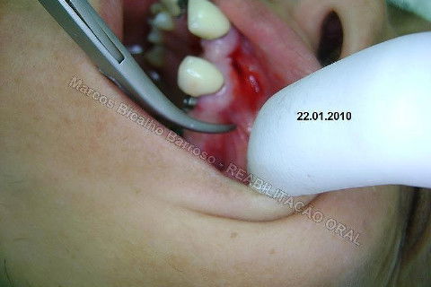 Reabilitação Oral - 10 Implantes Maxila e Mandíbula - Parte I - Planejamento