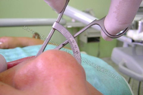 Reabilitação Oral - 10 Implantes Maxila e Mandíbula - Parte I - Planejamento