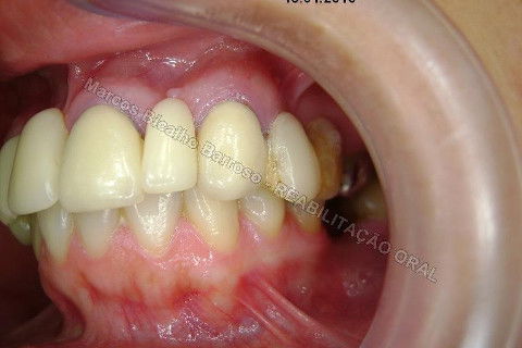 Reabilitação Oral - 10 Implantes Maxila e Mandíbula - Parte I - Planejamento