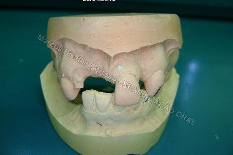 Reabilitação Oral - 10 Implantes Maxila e Mandíbula - Parte I - Planejamento