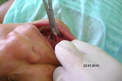 Reabilitação Oral - 10 Implantes Maxila e Mandíbula - Parte I - Planejamento